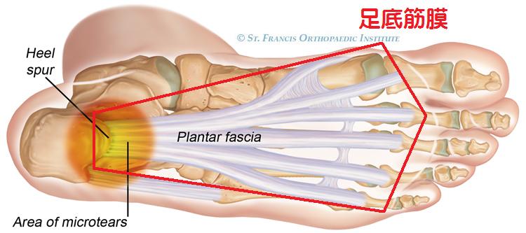足底筋膜炎（足裏・かかとの痛み）　part2