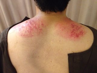慢性肩こり 慢性肩こり