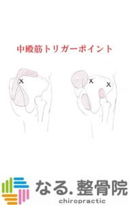 中殿筋トリガーポイント