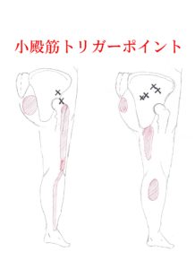 小殿筋トリガーポイント