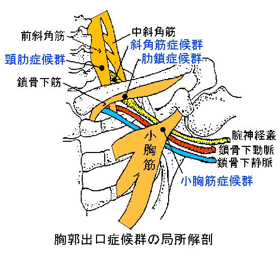 胸郭出口症候群