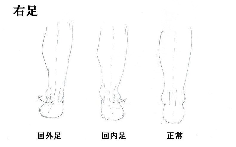 中・高校生のスポーツ選手に多い怪我⑦･･･踵骨骨端症